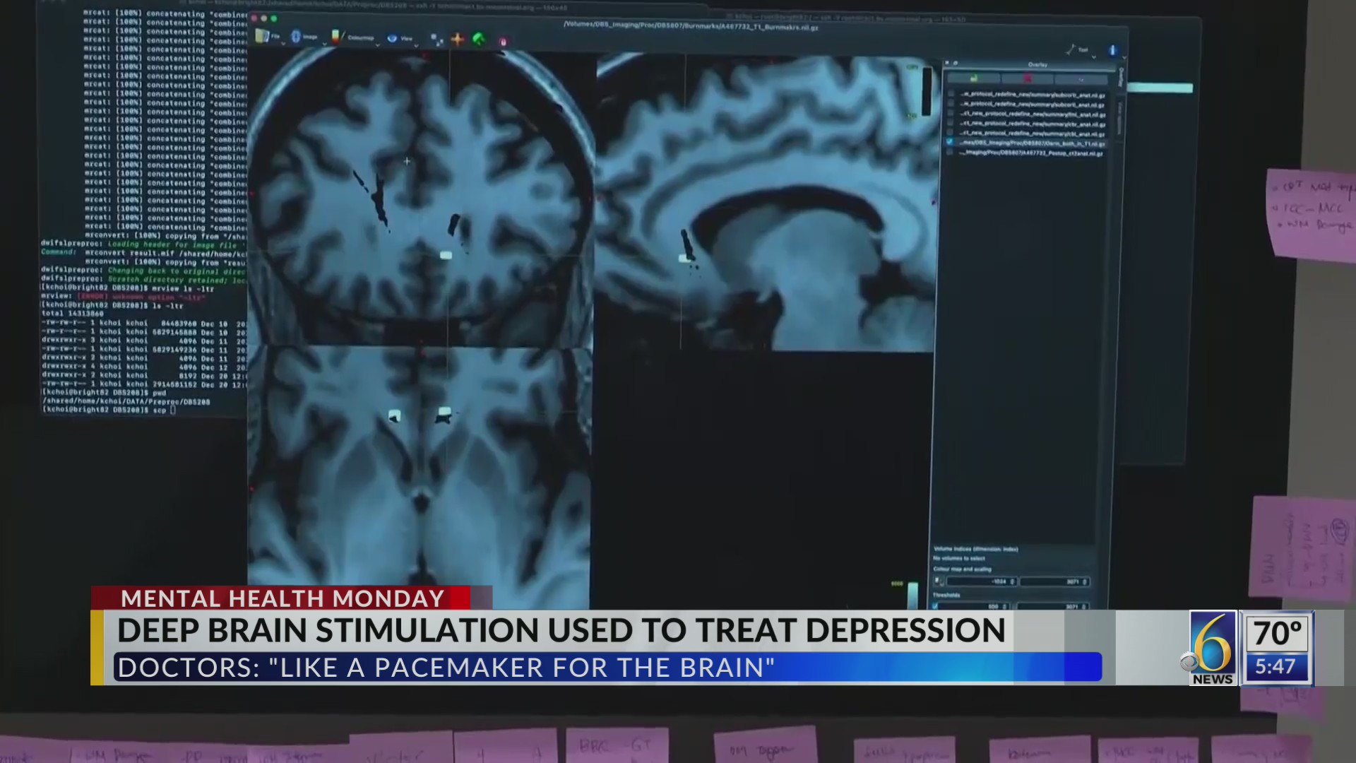 Mental Health Monday: Deep Brain Stimulation Treatment For Depression