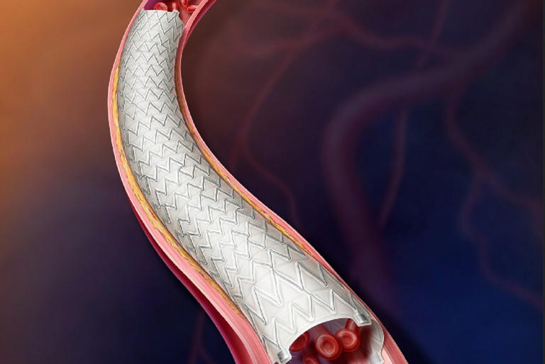 BD launches PAD treatment study with vascular-covered stent