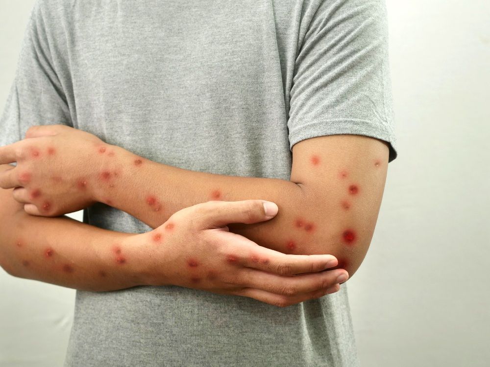 What To Know About Measles — One Of The Most Contagious Diseases