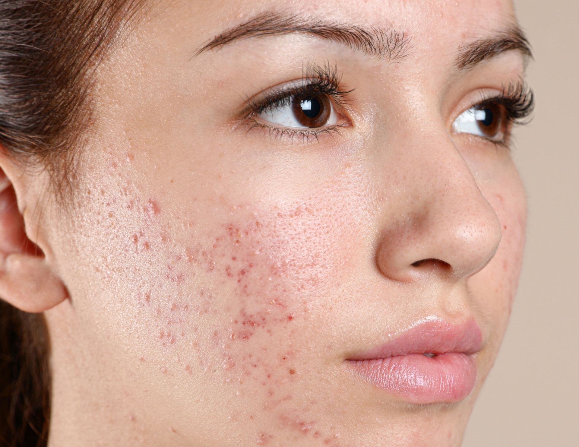 Facing up to the skin condition called rosacea