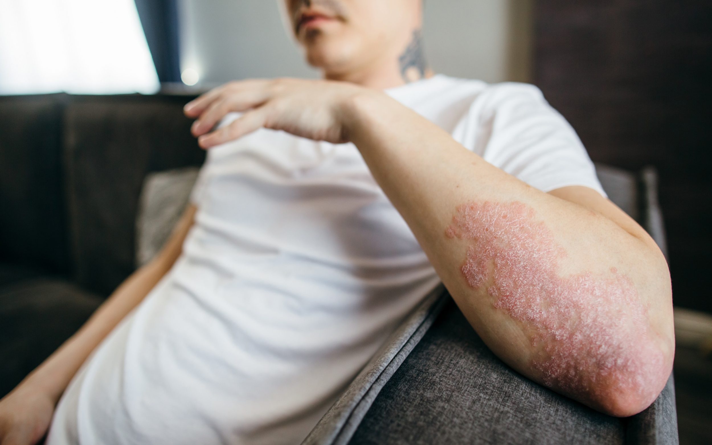 how to, the triggers of psoriasis and how to treat it