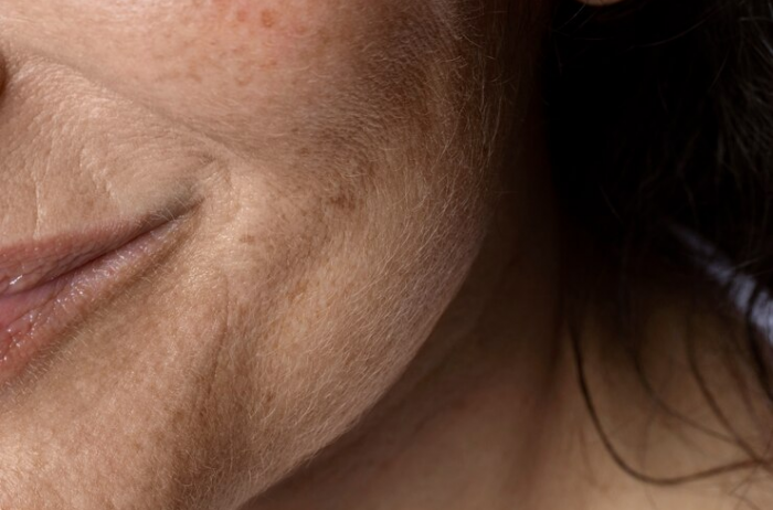 melasmas: ¿cómo detectar manchas solares en la piel, por qué aparecen y qué tratamientos hay?