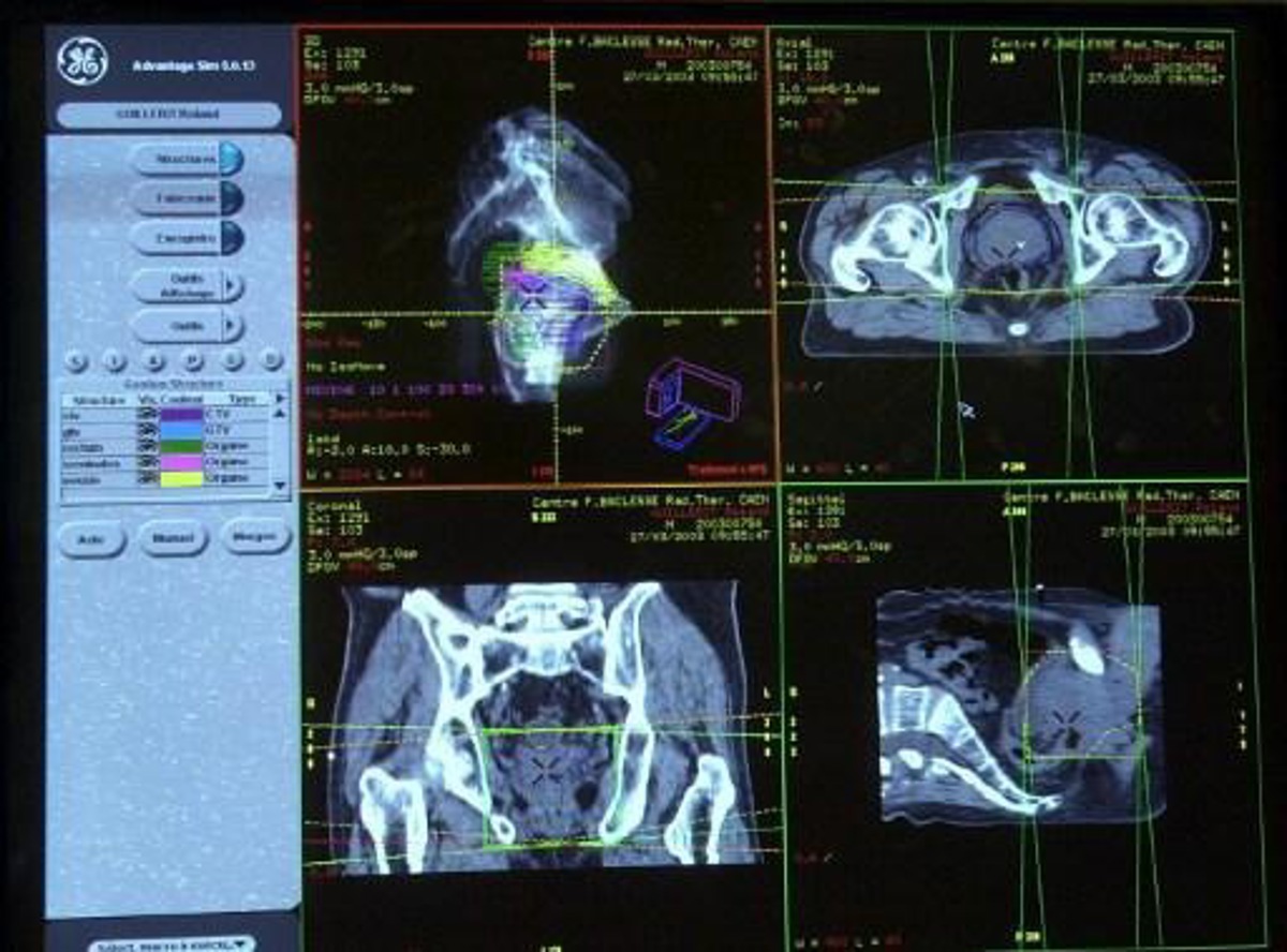 une première tumeur du col de l'utérus traitée par radiothérapie adaptative en belgique