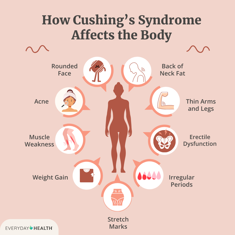 What Is Cushing’s Syndrome? Symptoms, Causes, Diagnosis, and Treatment