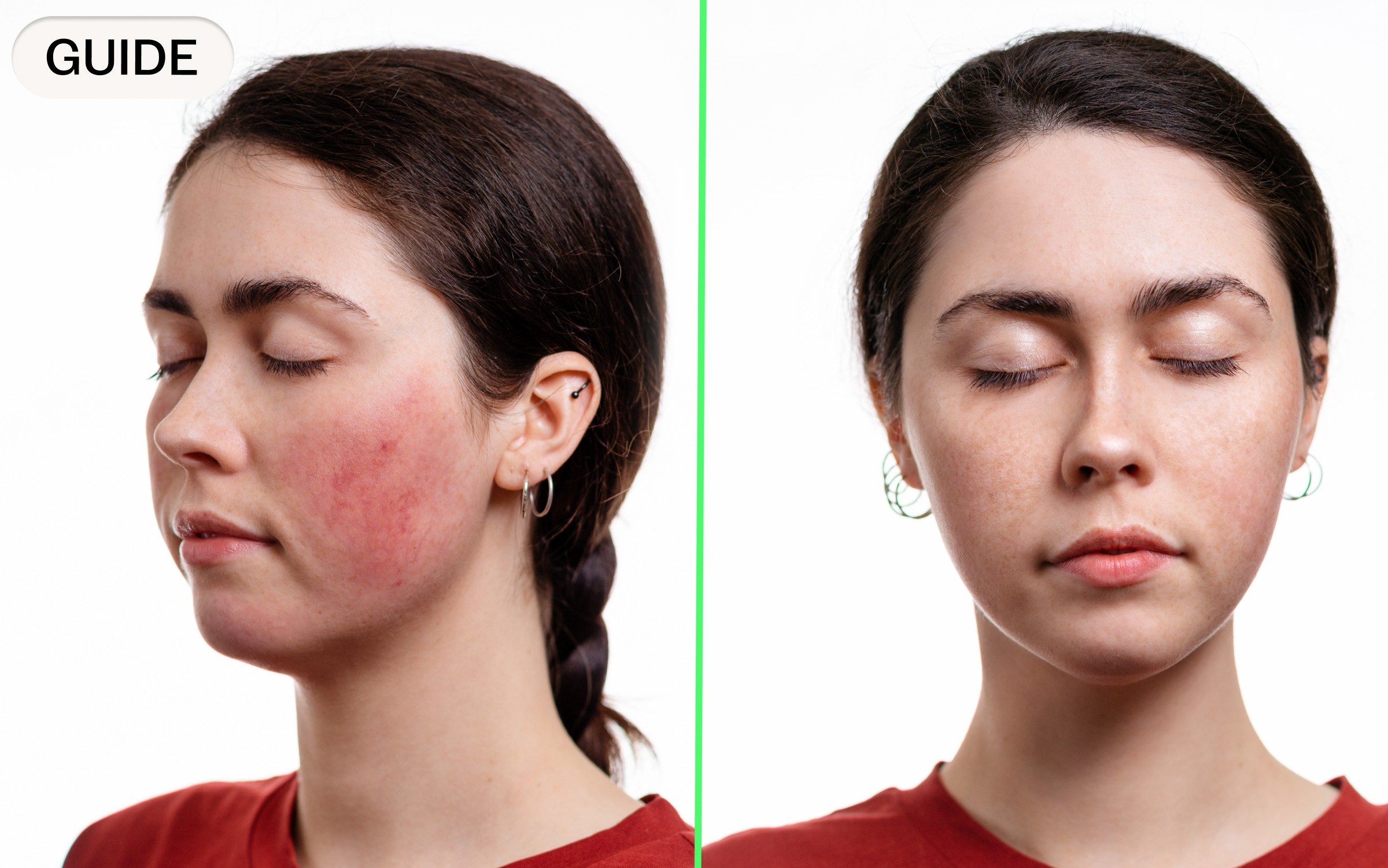 how to, how to manage rosacea: from common triggers to the best treatments