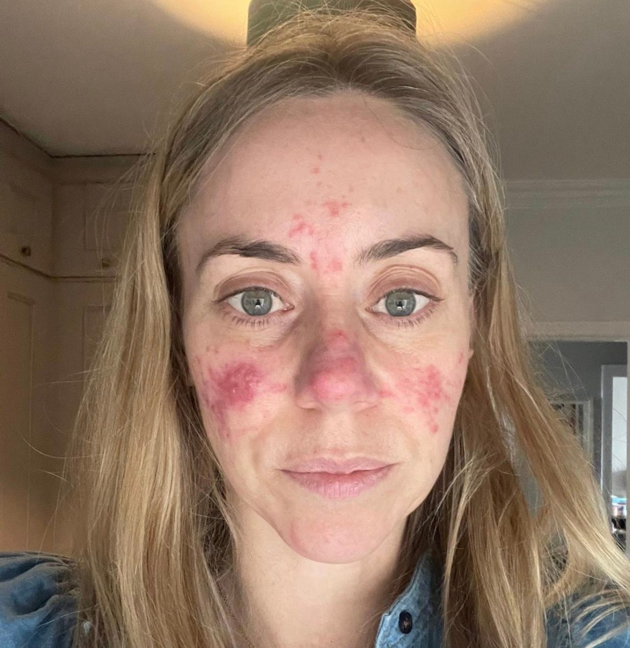how to, how to manage rosacea: from common triggers to the best treatments