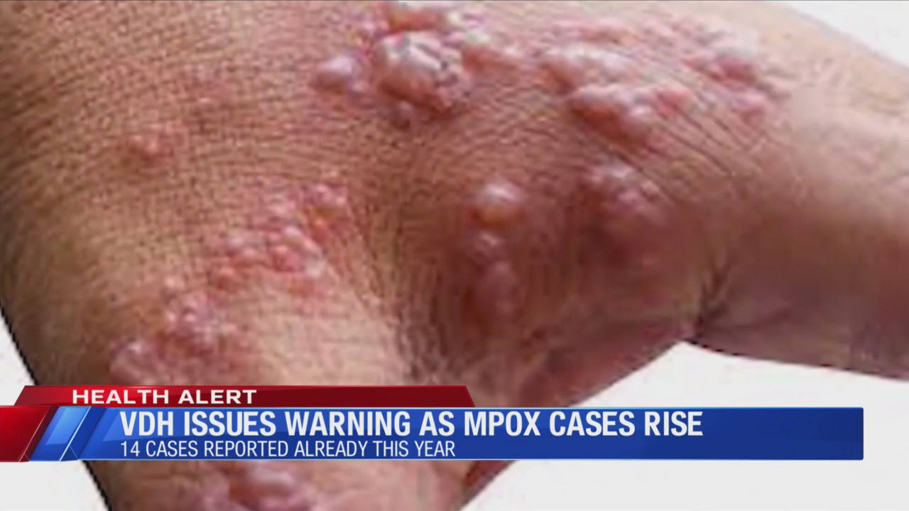 VDH issues warning as Monkey Pox cases rise in the state