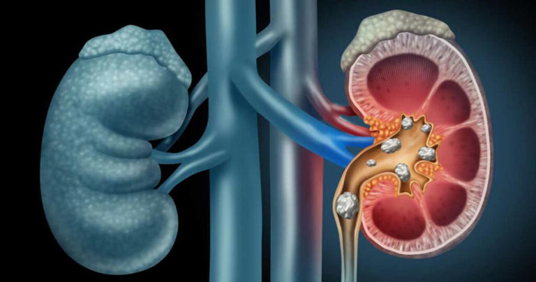 The kidneys are two small bean-shaped organs located on either side of the spine, just below the ribcage. Their main function is to filter the blood, removing waste products, and excess fluids from the body. The kidneys also help control blood pressure, produce red blood cells, and maintain the balance of electrolytes, such as sodium, potassium, and calcium. When the kidneys are healthy, they filter around 120 to 150 quarts of blood daily, producing about 1 to 2 quarts of urine. (1)