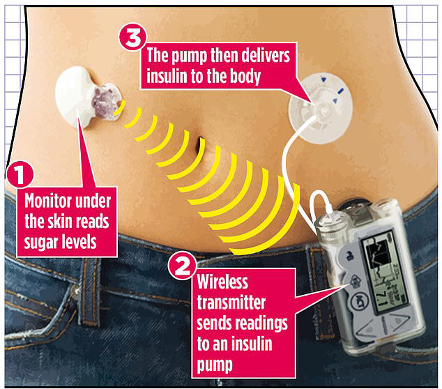 World-first artificial pancreas roll-out will see up to 150,000 ...