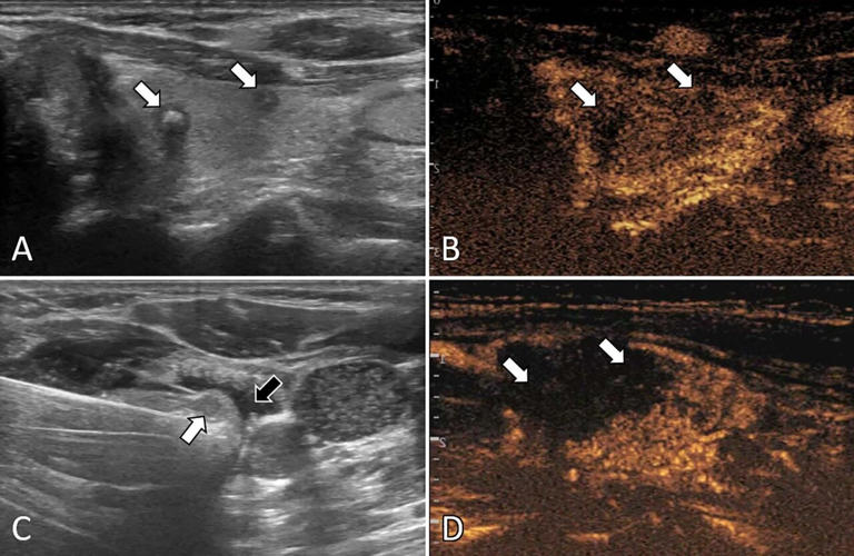 Ultrasound (US) images in a 57-year-old female patient with multifocal papillary thyroid carcinoma (PTC). (A) Routine US scan shows two hypoechoic PTC nodules (arrows) in the left lobe. (B) Preablation contrast-enhanced US image shows hypoenhancement in the arterial phase (arrows). (C) Isolating fluid (black arrow) is used to protect the muscles beside the nodule (white arrow) during the ablation. (D) Postablation contrastenhanced US image shows no enhancement in the original tumor zone (arrows). Credit: Radiological Society of North America (RSNA)