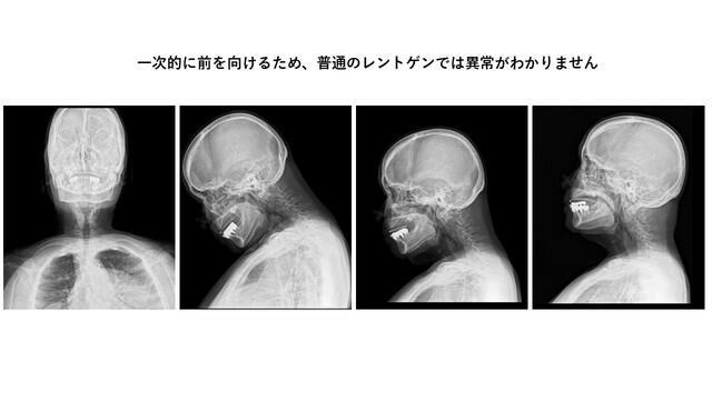 高齢者のスマホ利用に「思わぬ危険」が潜んでいた…急増する「首下がり症」の症状と予防・対策法