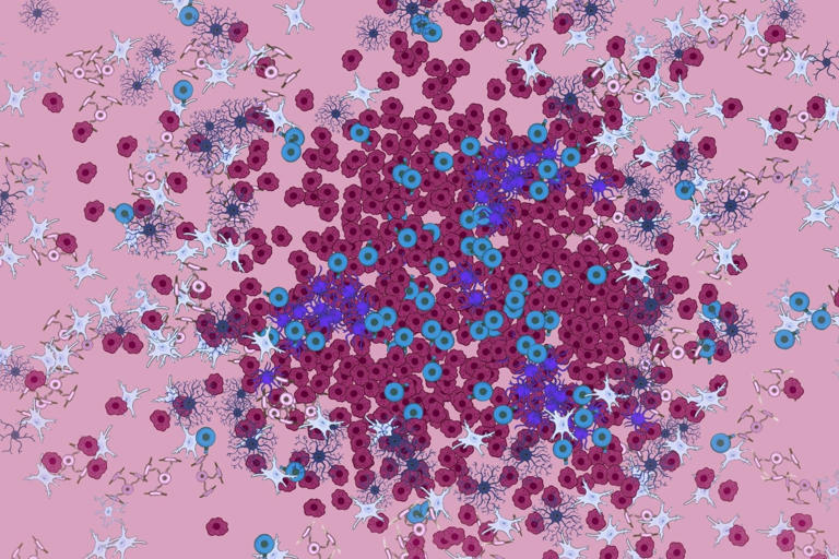 Decoding The Dynamics Of Multiple Sclerosis Lesions