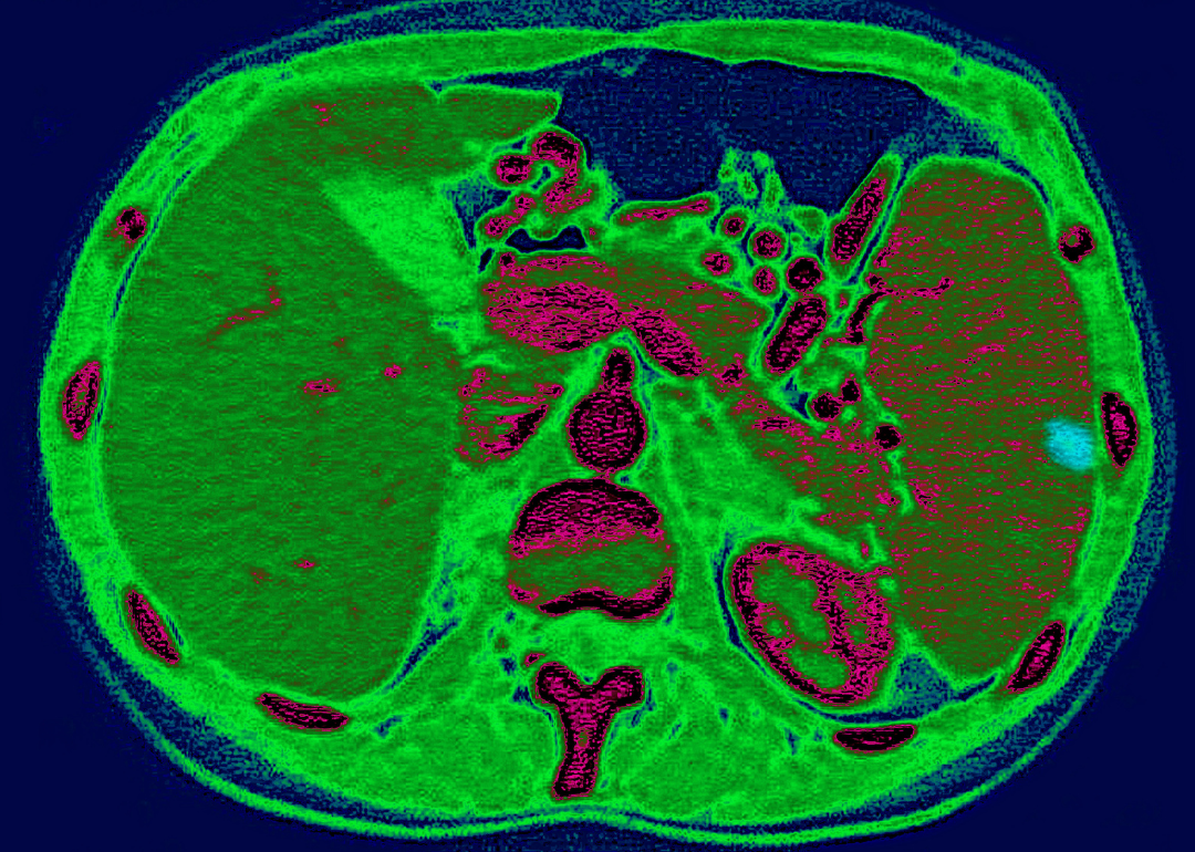 <p>Roughly the size of an avocado in adults, your spleen rests within the left rib cage above the stomach and is part of the lymphatic system. This organ <a href="https://my.clevelandclinic.org/health/body/21567-spleen">performs a variety of functions that keep the body healthy</a>, including storing and filtering blood; producing white blood cells and antibodies; and maintaining internal fluid levels. The spleen is particularly susceptible to injury and disorders, and some individuals may have to have the organ removed via a splenectomy.</p>
