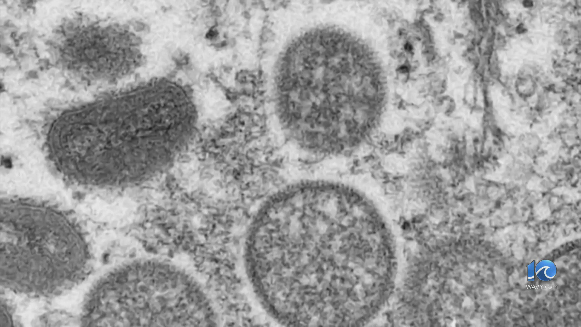 Rise in mpox cases in Virginia