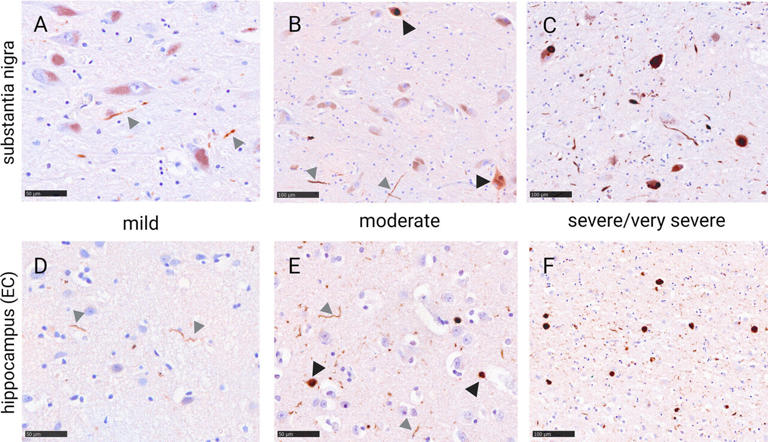 Common degenerative brain disease may begin to develop already in ...