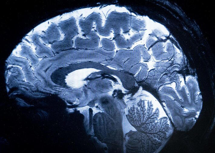 O "Iseult" forneceu suas primeiras imagens do cérebro humano e espera-se que ele permita uma melhor compreensão de seu funcionamento e de certas doenças neurodegenerativas e psiquiátricas. A façanha técnica é o resultado de uma parceria franco-alemã que exigiu mais de 20 anos de pesquisa. Foto: ALAIN JOCARD / AFP