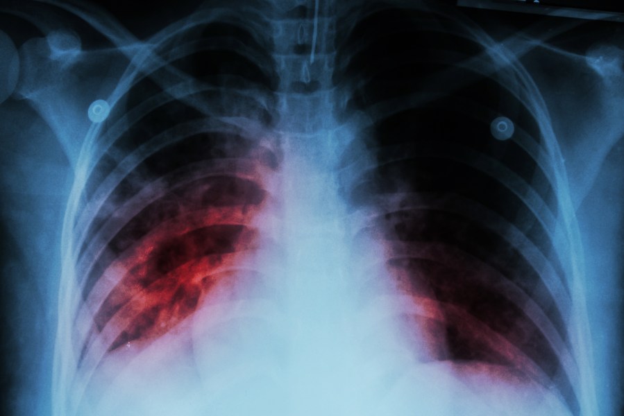 Kansas faces largest tuberculosis outbreak in state’s history