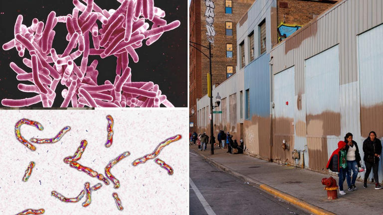 Tuberculosis under a microscope and a Chicago migrant shelter Getty Images