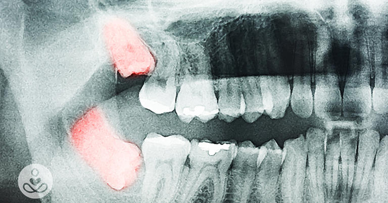 Wisdom Teeth Removal: Is Wisdom Tooth Surgery Really Necessary?