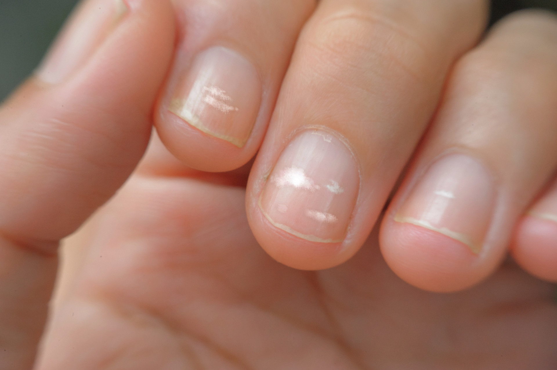 Белые пятна на ногтях причины у мужчин. Белые крапинки на ногтях рук. Коричневые полоски на ногтях. Белые пятна на ногтях причины у мужчин. Белые крапинки на ногтях рук.