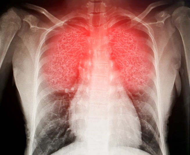desarrollan fármaco que podría regenerar el tejido del pulmón dañado por enfermedades crónicas