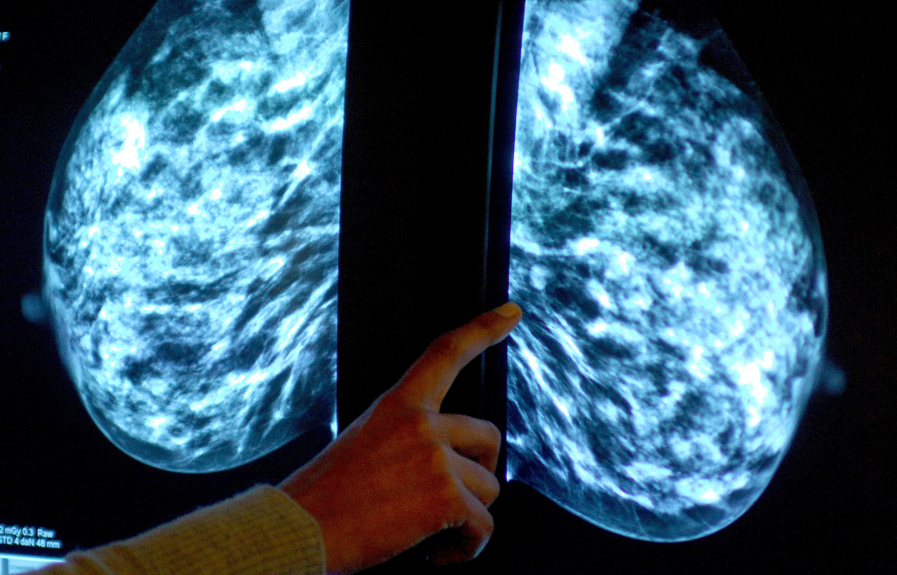 report suggests people with breast cancer are being ‘systematically left behind’
