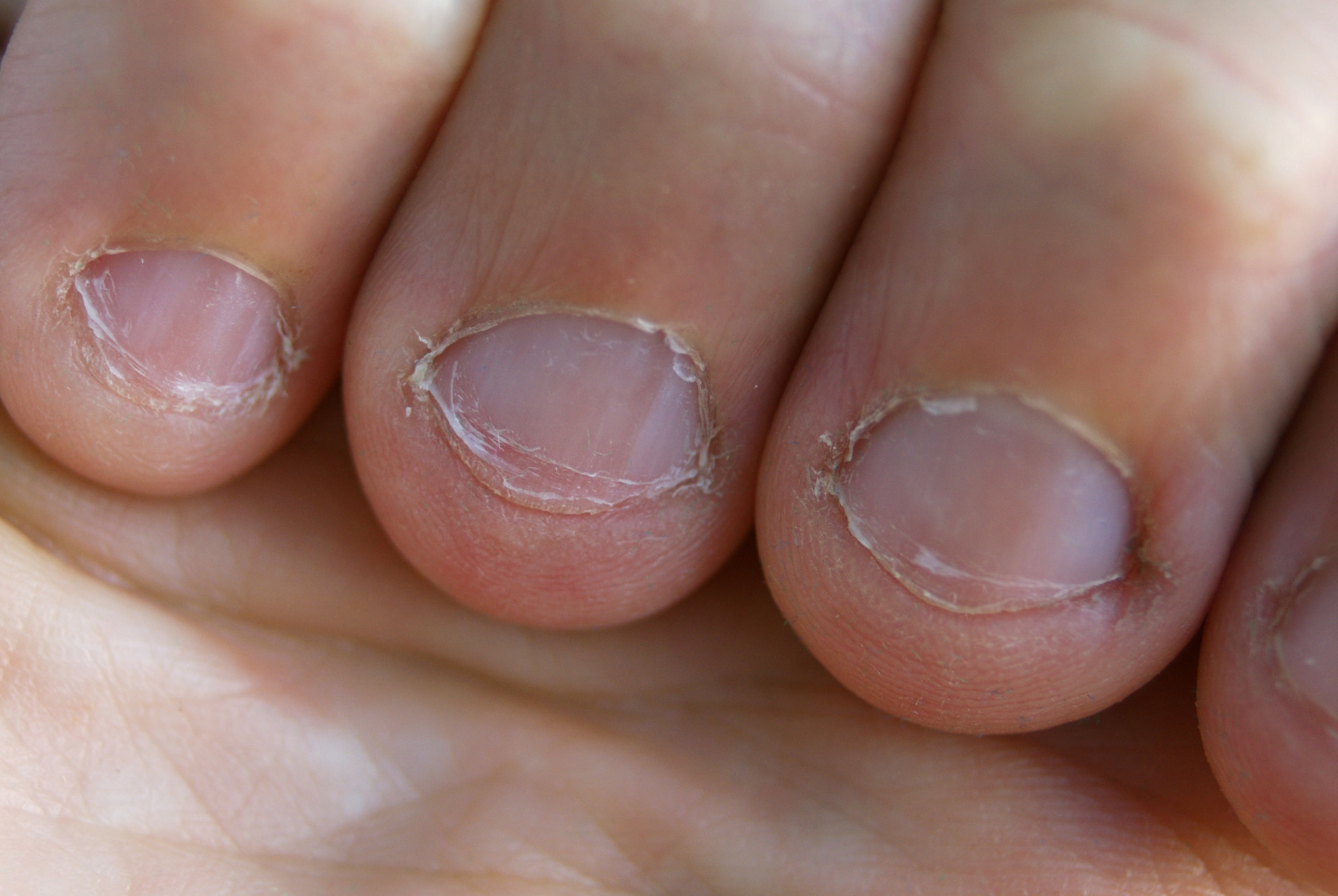 What your nails say about your health