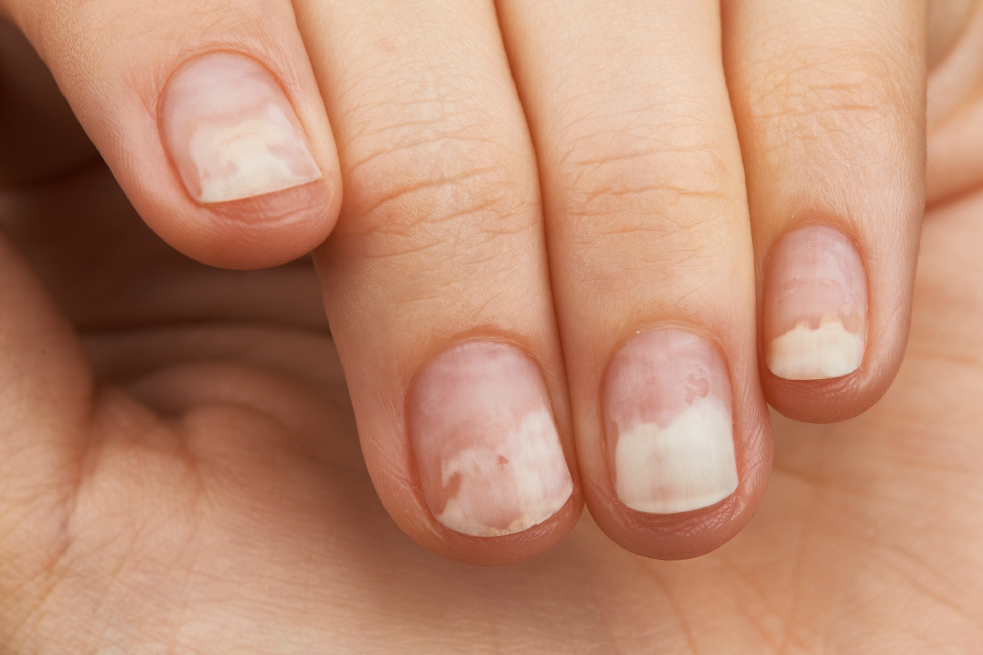 What your nails say about your health