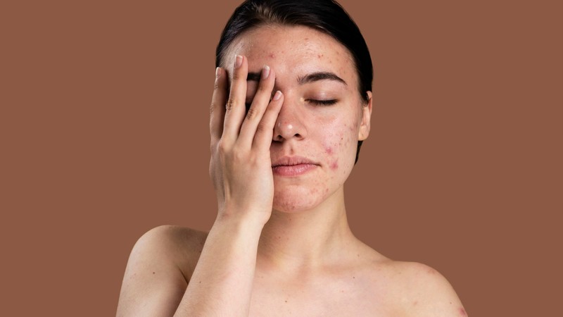 how to, tips on how to take care of acne-prone skin