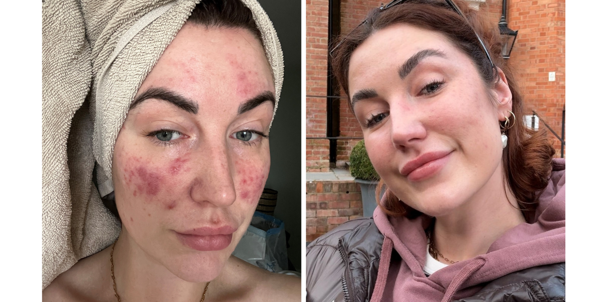from acne to rosacea, 3 women explain why they can't do without this dr jart cicapair product