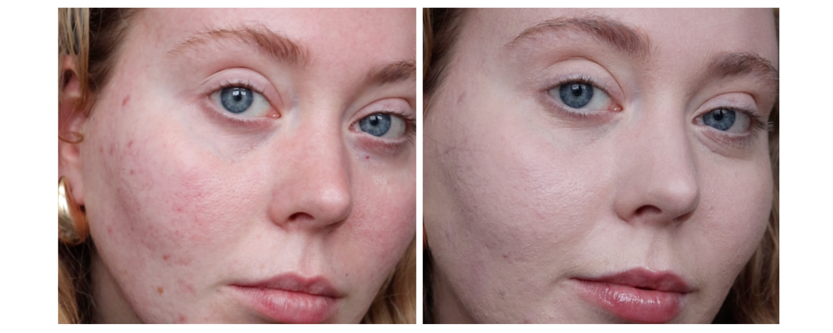 from acne to rosacea, 3 women explain why they can't do without this dr jart cicapair product