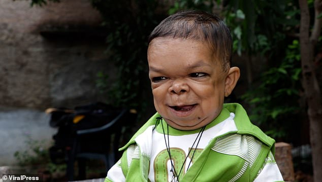 indian villager stopped growing aged five due to rare condition