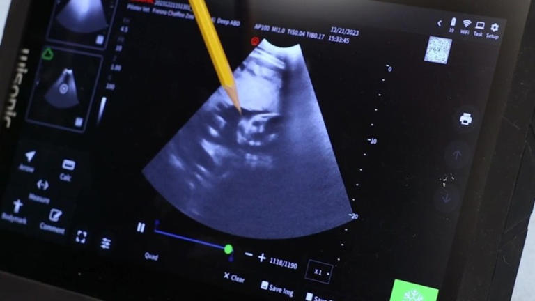 Watch: Pregnant Elephant Gets Ultrasound At Fresno Chaffee Zoo