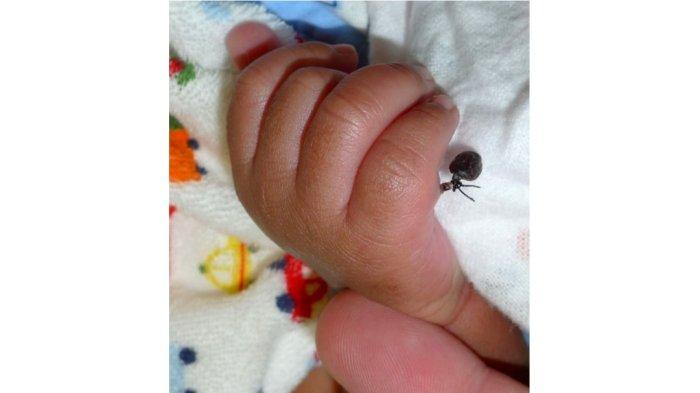mayapada hospital bandung berhasil tangani bayi yang lahir dengan 8 jari