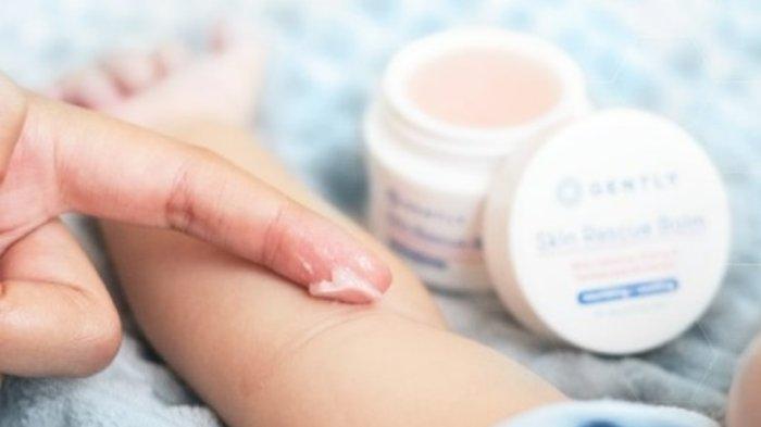 review gently skin rescue balm,pertolongan pertama biang keringat dan ruam kulit bayi