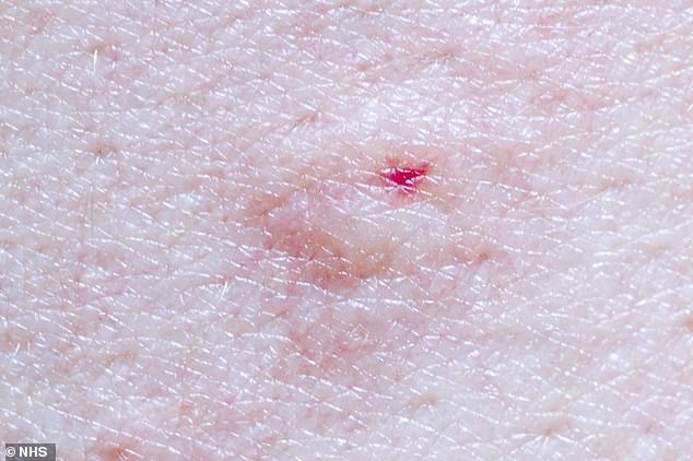 pharmacist warns over eight tell-tale skin marks from insect bites