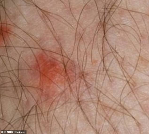 pharmacist warns over eight tell-tale skin marks from insect bites