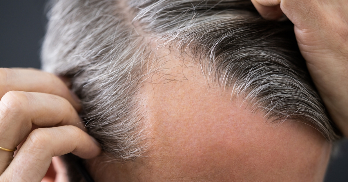 læge deler 8 årsager: derfor er du ved at miste håret