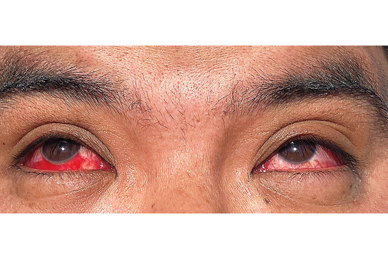 A dairy farm worker who suffered a subconjunctival hemorrhage after contracting avian flu (The New England Journal of Medicine ©2024)