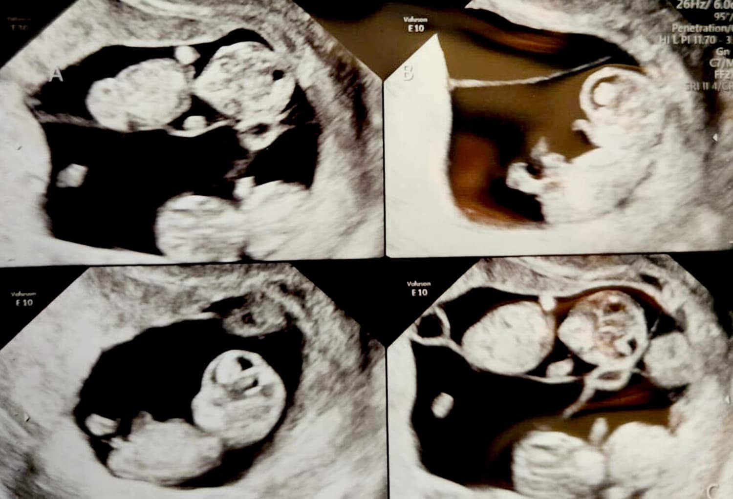 texas couple welcomes identical quadruplet girls: ‘holy moly!’