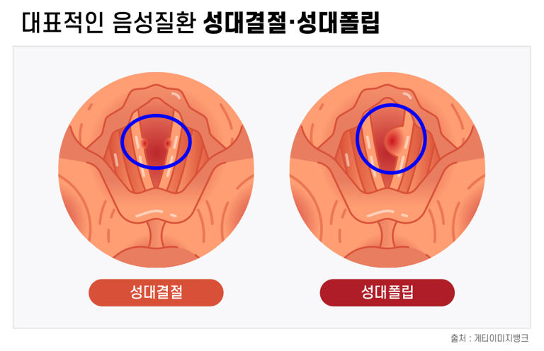 헛기침하는 습관, 성대에 굳은살 만들어… 쉰 목소리 난다면?