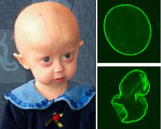 8 Rarest Genetic Disorders In The World