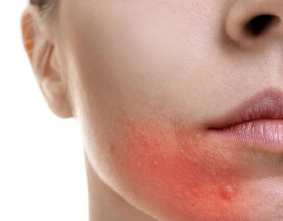 Skin irritations and blemishes