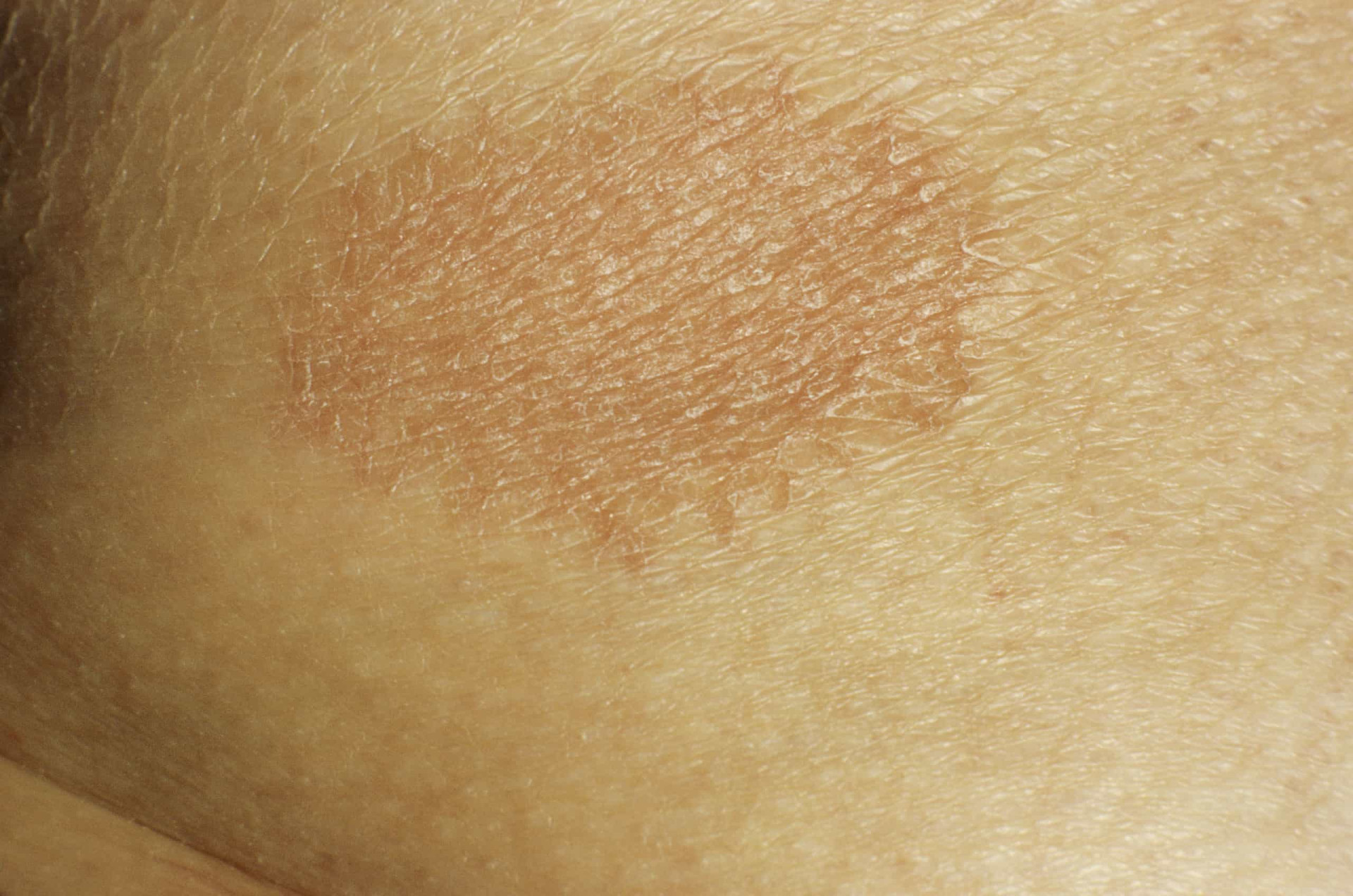 Dermatosis neglecta