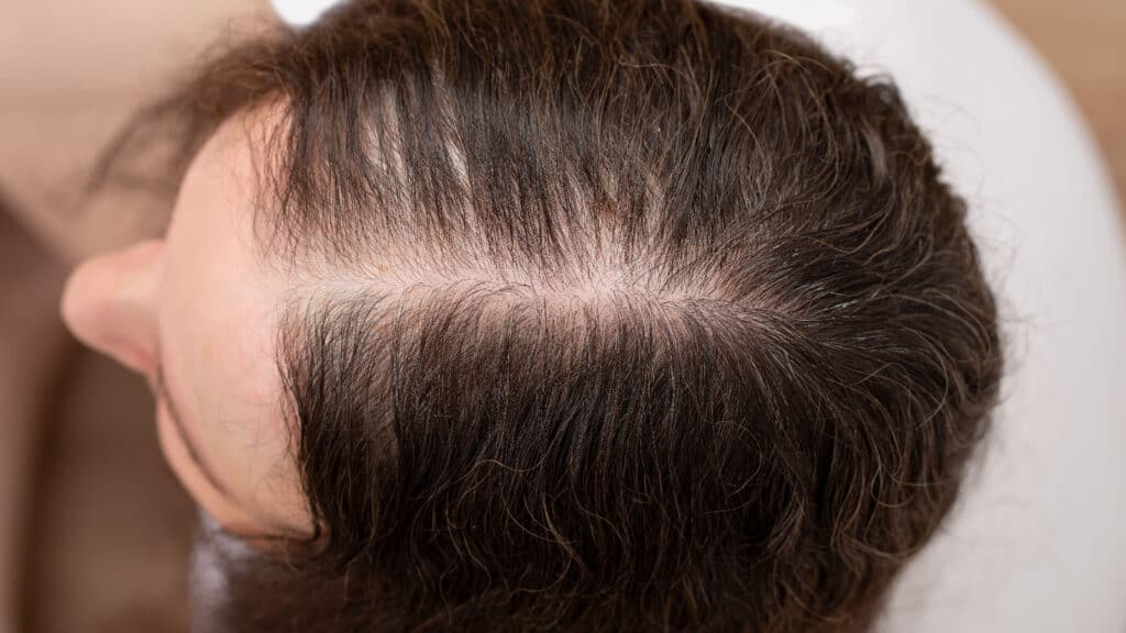 Why Your Hair Is Thinning And What You Can Do About It