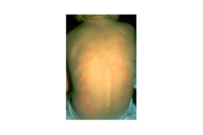 What’s That Rash? How To Id 14 Of The Most Common Skin Irritations