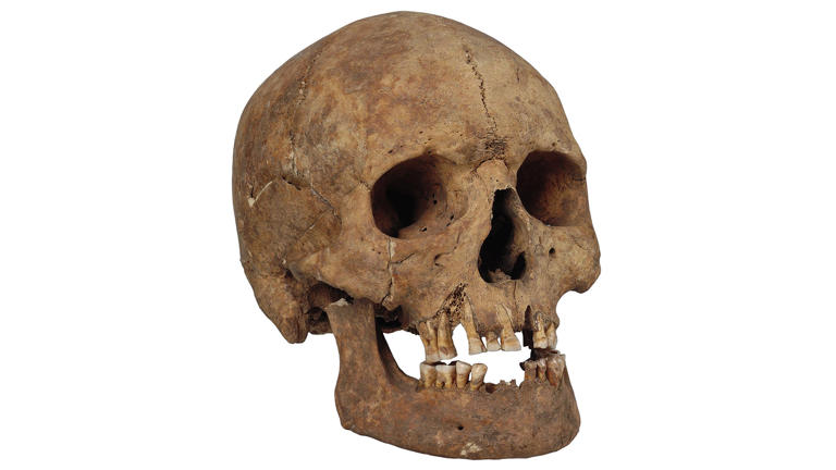 The skull of a man with filed teeth who was buried on Gotland during the Viking Age. The same graveyard held 12 other individuals with filed teeth. (Image credit: © SHM/Gabriel Hildebrand 2011-12-09 ( (CC BY 2.5 DEED) ))