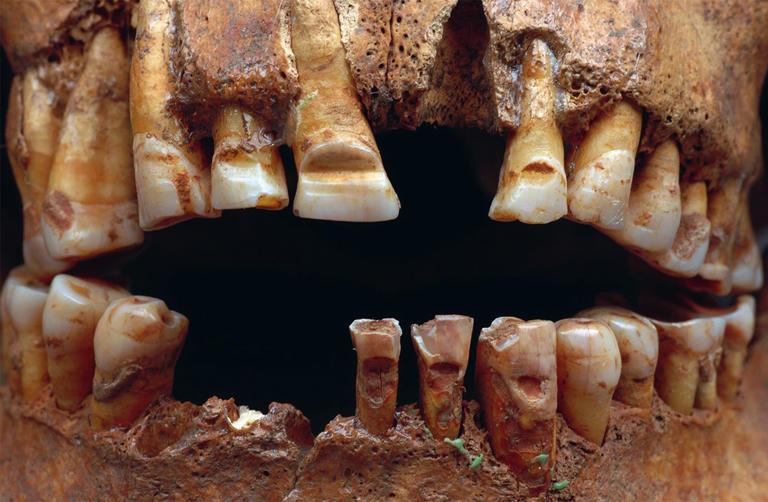 Detail of the skull shows the grooves deliberately made on the front teeth with an iron file, possibly as a clandestine form of identification. (Image credit: © SHM/Lisa Hartzell 2007-06-13 ( (CC BY 2.5 DEED) ))