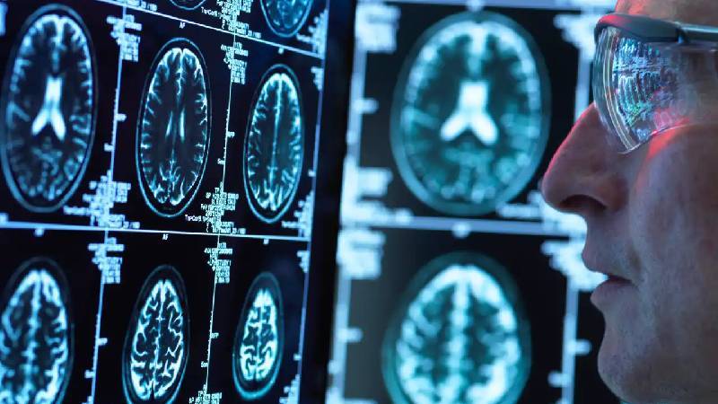 bilim insanları, alzheimer riskini düşürecek geni keşfetti