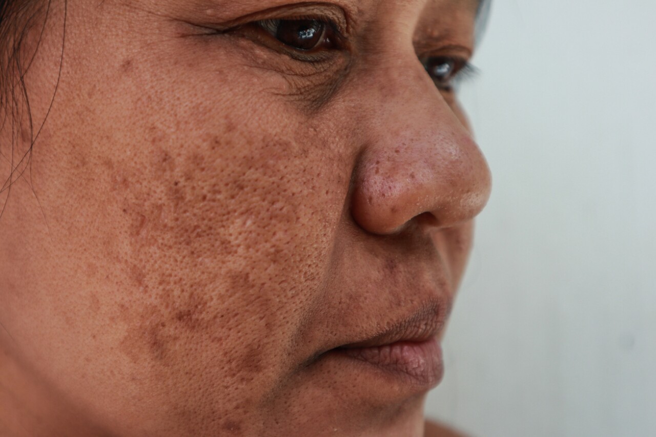 hiperpigmentación de la piel: causas, tipos y tratamientos caseros